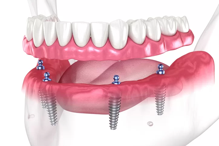 dental implants in gloucester